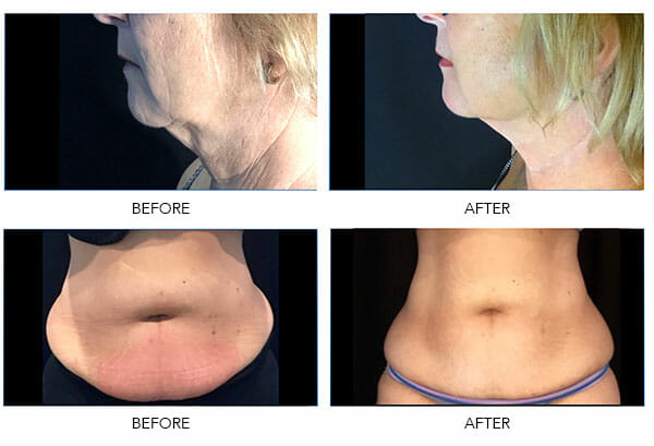 Below Body Bar Coolsculpting Before and After Results