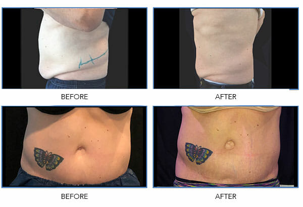 Below Body Bar Coolsculpting Before and After Results